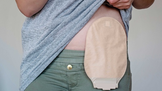 Derzeit gibt es nur wenige Daten zur Arzneimittelresorption bei Stomaträgerinnen und -trägern. © Shutterstock