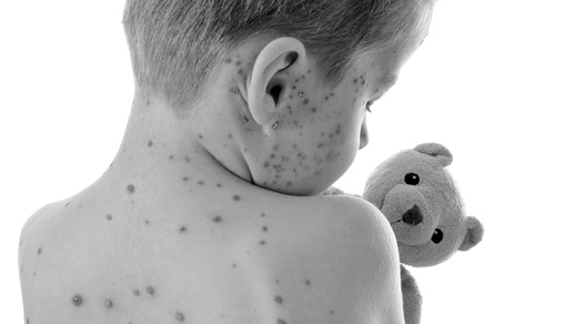 Masern © Shutterstock