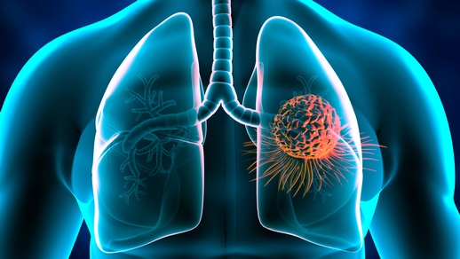 Lungenkrebs © Shutterstock