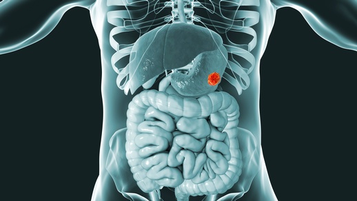 Themenbild Magenkrebs © Shutterstock