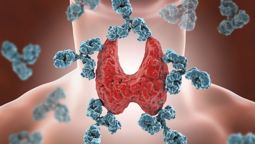 Bei der Hashimoto-Thyreoiditis wird durch die autoimmune Bildung zytotoxischer T-Lymphozyten und schilddrüsenspezifischer Antikörper eine chronische Entzündungsreaktion induziert. © Shutterstock