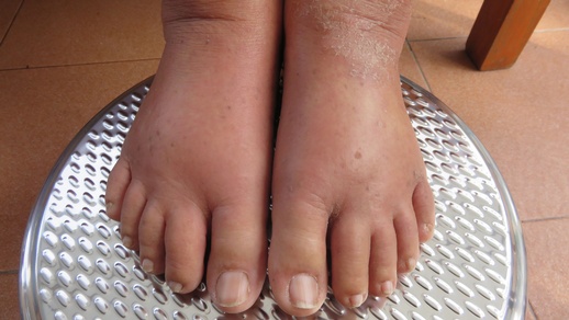 Ödeme an den Beinen © Shutterstock