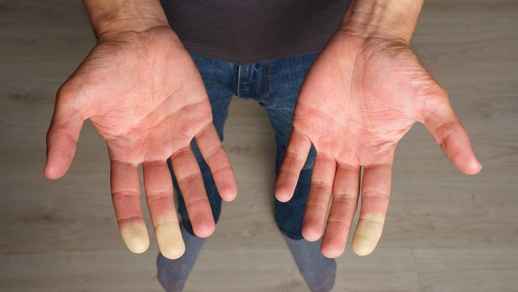Raynaud-Syndrom © Shutterstock