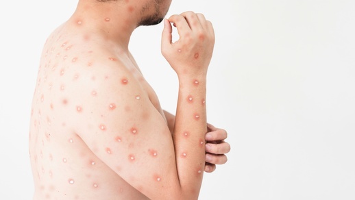 Mann mit Pusteln © Shutterstock