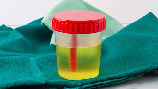 Urinprobe © Shutterstock