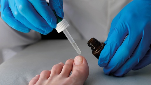 Reicht die lokale Therapie bei Nagelpilz nicht, kann mit Terbinafin systemisch therapiert werden. Geduld ist ­erforderlich: Eine Therapie kann evtl. > 6 Monate dauern. © Shutterstock