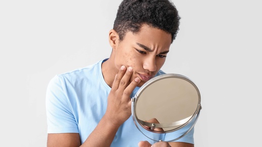 Themenbild Akne © Shutterstock