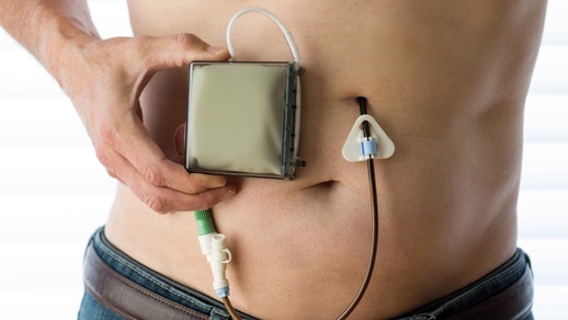 Für die Zukunft der subkutanen Levodopa-Therapie wird die lokale Verträglichkeit an der Infusionsstelle entscheidend sein.  © Shutterstock