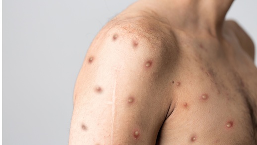 Themenbild Affenpocken © Shutterstock