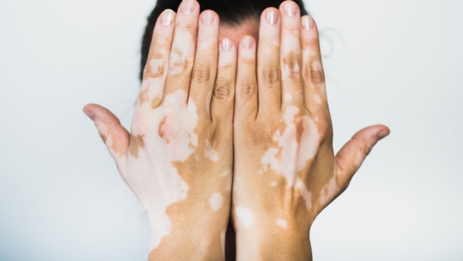 Vitiligo  © Shutterstock