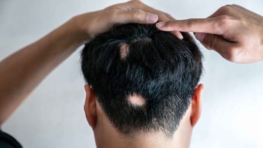 Kreisrunder Haarausfall © Shutterstock