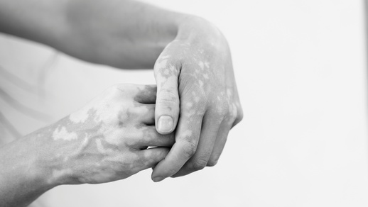 Vitiligo © Shutterstock
