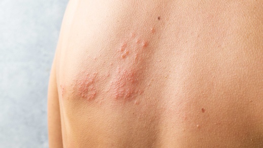 Gürtelrose © Shutterstock