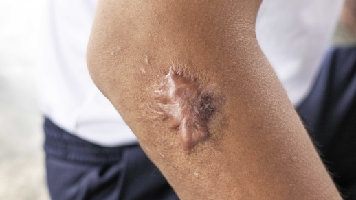 Bei hypertrophen Narben und Keloiden wuchert das Narbengewebe über das Gebiet der ursprünglichen Wunde hinaus. © Shutterstock