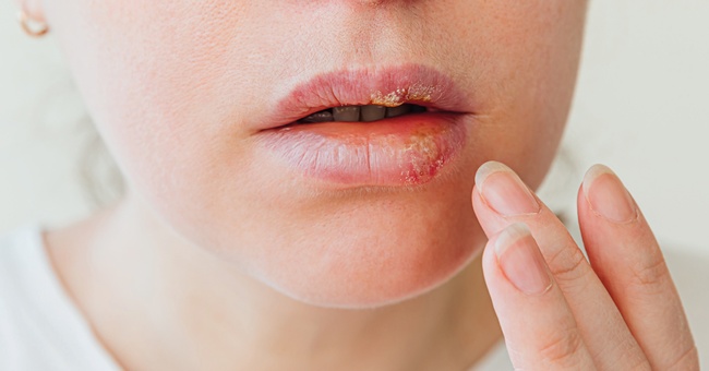 Fieberblasen © Shutterstock