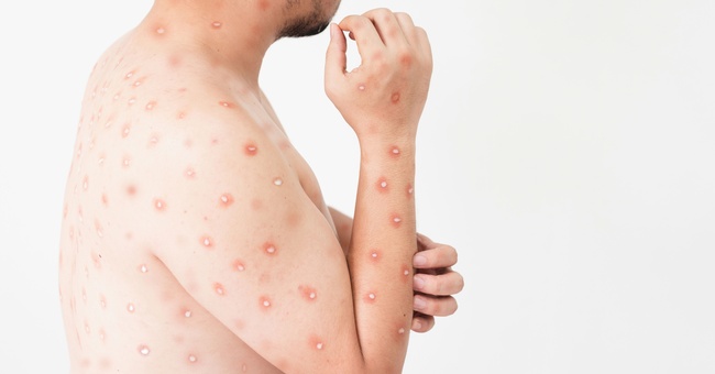 Mann mit Pusteln © Shutterstock