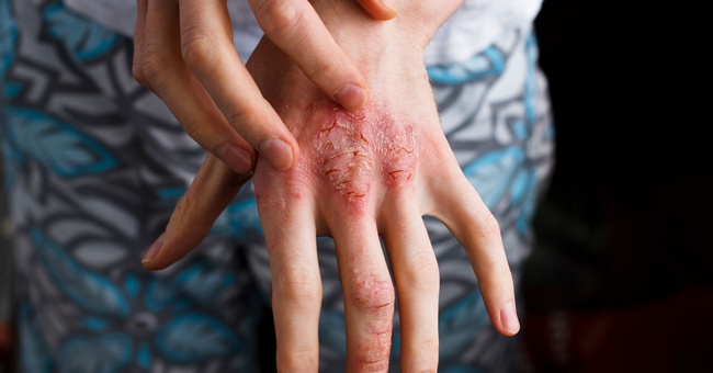 Atopische Dermatitis © Shutterstock