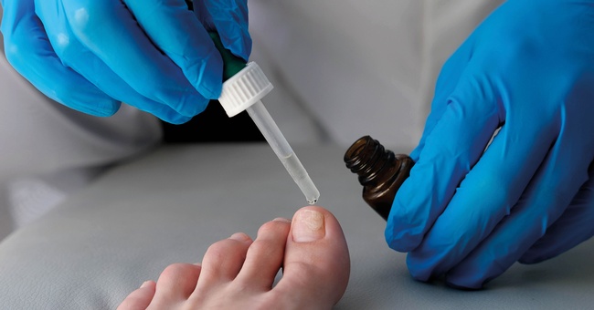 Reicht die lokale Therapie bei Nagelpilz nicht, kann mit Terbinafin systemisch therapiert werden. Geduld ist ­erforderlich: Eine Therapie kann evtl. > 6 Monate dauern. © Shutterstock