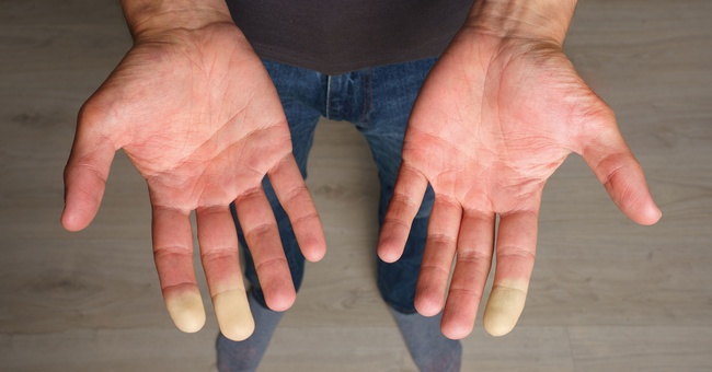 Raynaud-Syndrom © Shutterstock