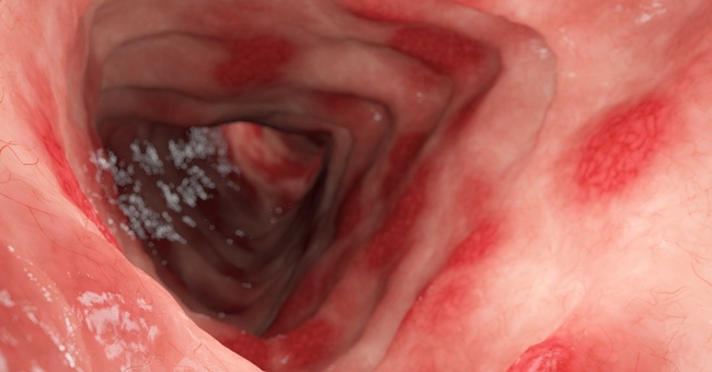 Colitis ulcerosa © Shutterstock