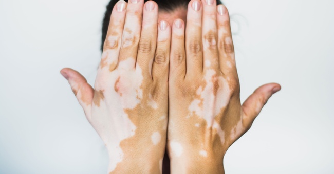 Vitiligo  © Shutterstock