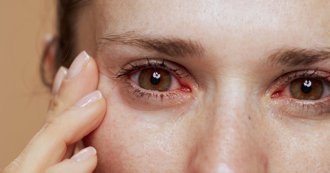 Sjögren-Syndrom © Shutterstock