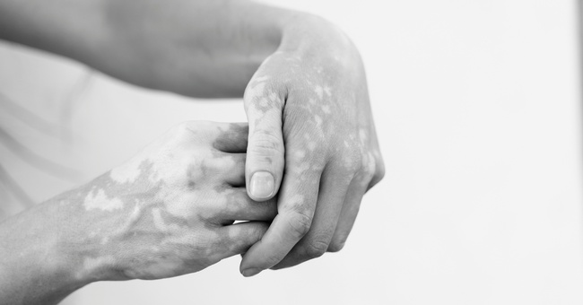 Vitiligo © Shutterstock