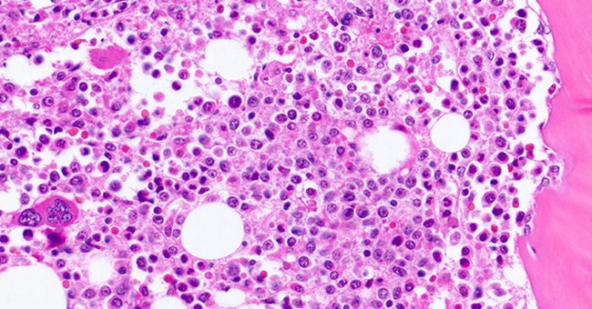 Mikroskopische Sicht der Myelofibrose © shutterstock