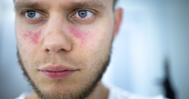 Systemischer Lupus erythematodes © Shutterstock