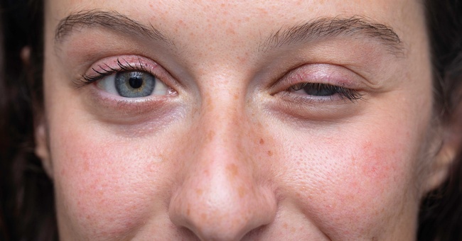 Bei der okularen Mysthenia gravis nimmt der Tonus der Augenmuskulatur ab, wodurch die Augenlider der Erkrankten herabhängen (Ptosis). © Shutterstock