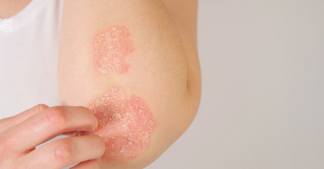 Rötlich umrandete, scharf begrenzte Herde mit silbrig-glänzenden Schuppen sind typisch für Psoriasis. © Shutterstock