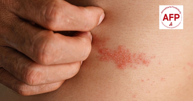 Post Zoster © Shutterstock/APOVERLAG