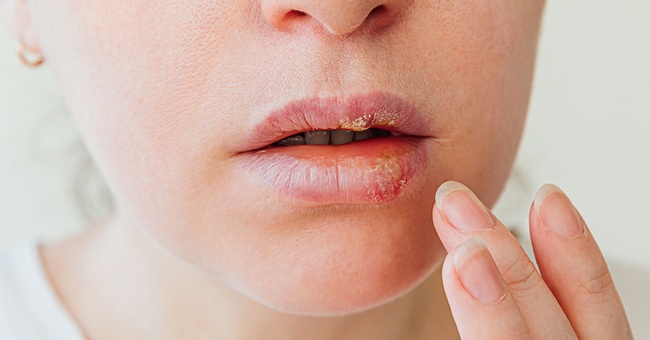 Herpes-Viren © shutterstock