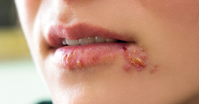Herpes © shutterstock