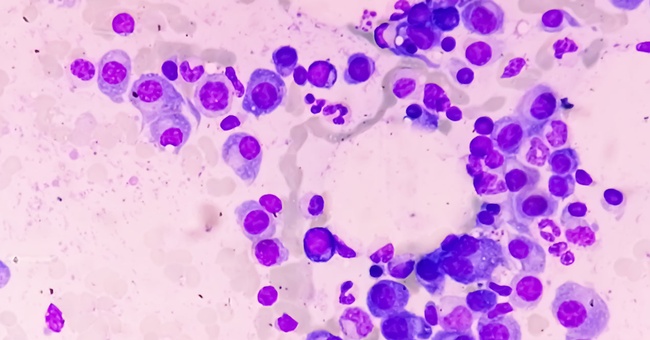 multiple Myelom © shutterstock