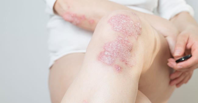 Psoriasis © Shutterstock