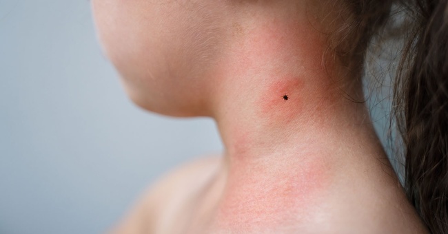 Zeckenstich &copy; Shutterstock