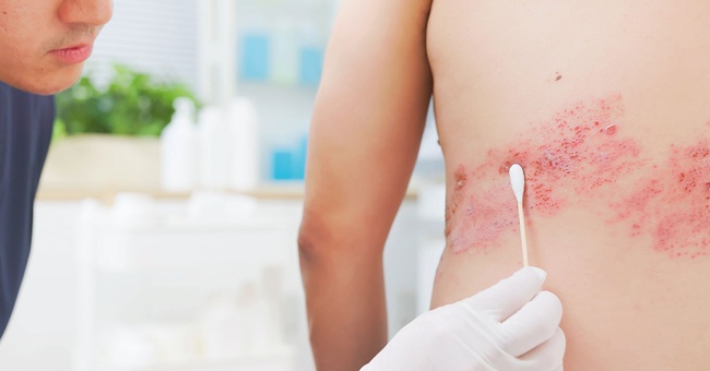 Herpes Zoster © iStock