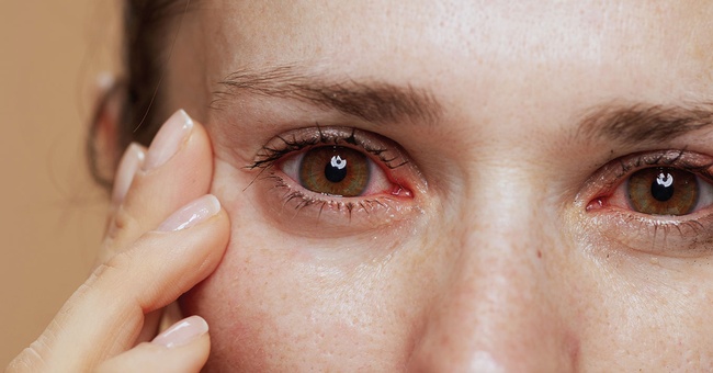 Bindehuatentzünung © iStock