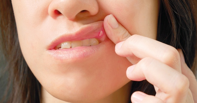 Aphthen und aphthoide Läsionen. © iStock