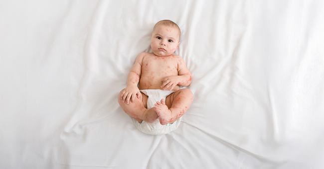 Baby mit Masern © Shutterstock