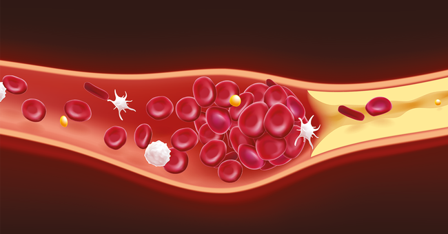 Thrombose © Shutterstock
