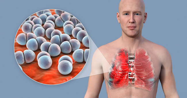Pneumokokken &copy; shutterstock