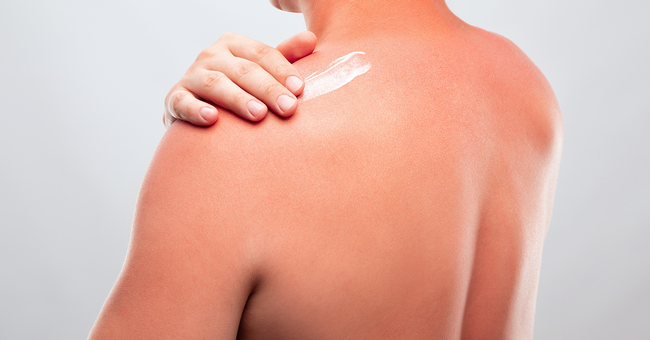 Sonnenbrand © Shutterstock
