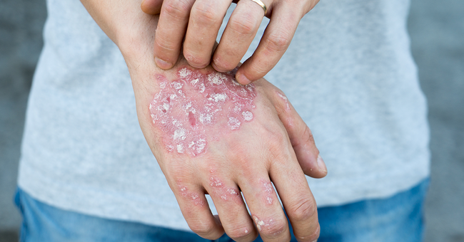 Plaque-Psoriasis © Shutterstock
