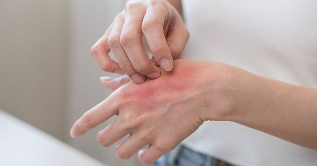 Allergische Reaktion © shutterstock