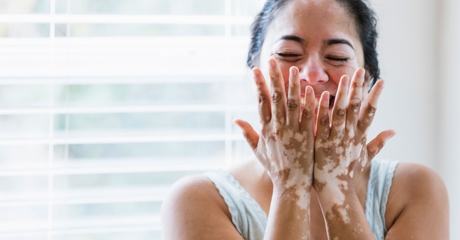 Vitiligo © iStock