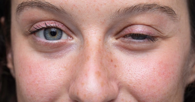 Myasthenia gravis © Shutterstock