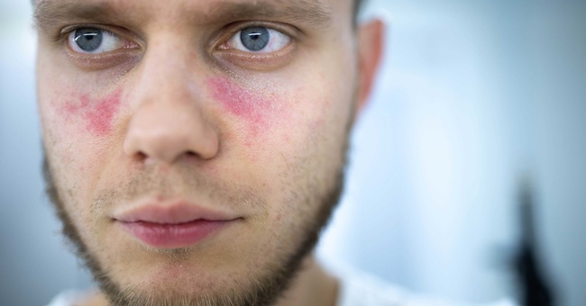 Lupus © Shutterstock