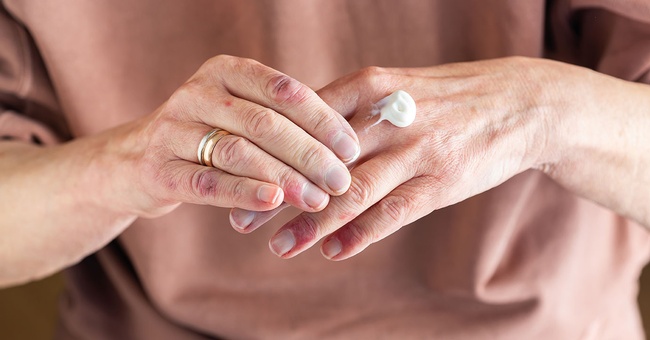 Creme für Neurodermitis © iStock